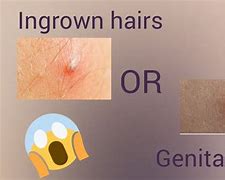 Image result for Genital Wart Biopsy