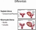 Image result for Uterus Didelphys. Size: 126 x 104. Source: desabafesbynina.blogspot.com