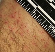 Image result for Severe Bed Bug Bites