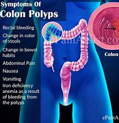 Image result for Symptoms of Polyps in Colon