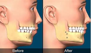Image result for Jaw Surgery Procedure