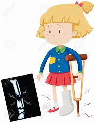 Image result for Broken Leg Clip Art