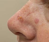 Image result for Skin Cancer Rash Neck