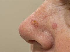 Image result for Head and Neck Cancer Face