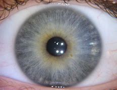 Image result for Anemia Ring Iris