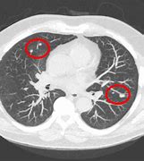 Image result for Non Calcified Lung Nodule