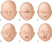 Image result for Interhemispheric Variant of Holoprosencephaly