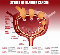 Image result for Tumor Sizes in mm