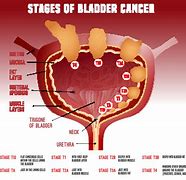 Image result for High Grade Bladder Cancer