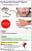 Image result for How Common Is Fifth Disease