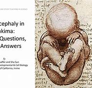 Image result for Anencephaly Drawing