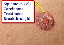 Image result for Squamous Cell Carcinoma Skin Cancer Treatment