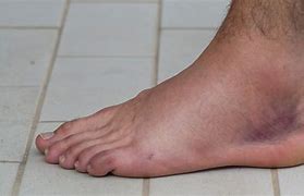 Image result for How Long Does Sprained Ankle Take to Heal