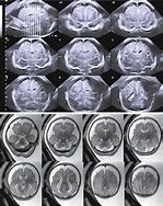 Image result for Hydrocephalus Ex Vacuo