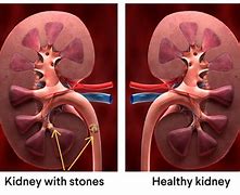 Image result for Complex Cyst On Kidney