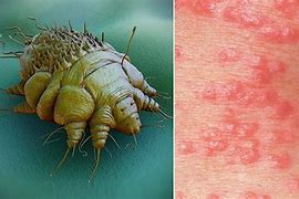 Image result for Scabies