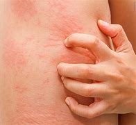 Image result for Allergic Skin Rash Treatment