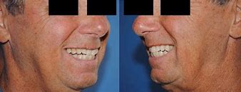 Image result for Flap Design Oral Surgery