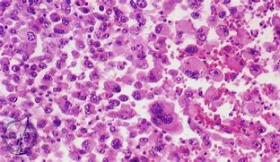 Image result for Large Cell Lung Cancer