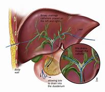 Image result for Biliary Drain Placement