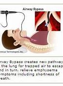 Image result for Airway Bypass