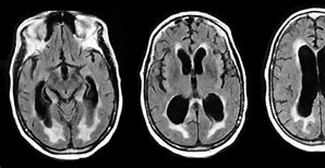 Image result for Normotensive Hydrocephalus Signs
