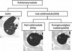 Image result for Ground Glass Nodule in Lung
