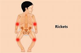 Image result for Rickets Animation