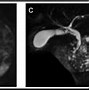 Image result for Pancreatic Intraductal