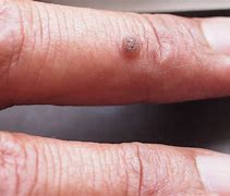 Image result for Types of Warts
