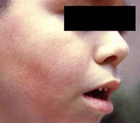 Image result for Fifthe Rash