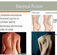 Image result for Abnormal Posture