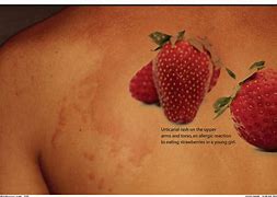 Image result for Allergic Reaction to Strawberries Rash