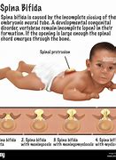 Image result for Spina Bifida Myeloschisis