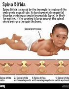 Image result for Spina Bifida Occulta