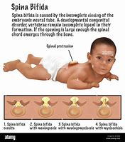 Image result for Babies with Spina Bifida