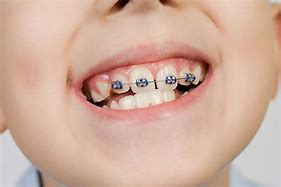 Image result for Braces for Kids