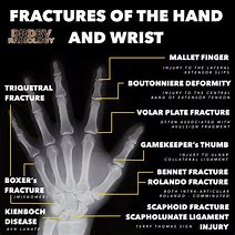 Image result for Types of Hand Injuries