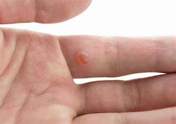 Image result for Wart Looks Like a Blister