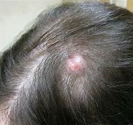 Image result for Cancerous Lumps On Head