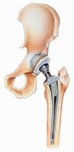 Image result for What Does a New Hip Replacement Look Like
