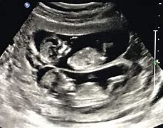 Image result for 12 Weeks Pregnant Ultrasound Twins