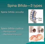 Image result for Types of Spina Bifida Occulta