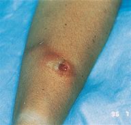 Image result for Forearm Nodules