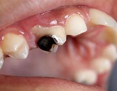 Image result for Little Kids Rotten Teeth