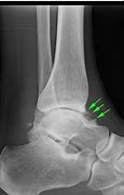 Image result for Bone Spur Ankle Joint