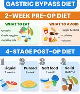 Image result for Bariatric Diet Stages