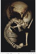 Image result for Second-Trimester Sirenomelia