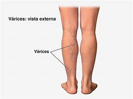 Image result for Varices Sintomas