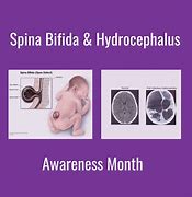 Image result for Anencephaly Craniorachischisis Spina Bifida
